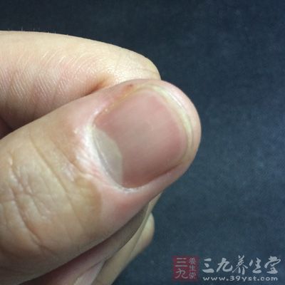 指甲出現(xiàn)白點或絮狀白斑 指甲出現(xiàn)白點或絮狀白斑